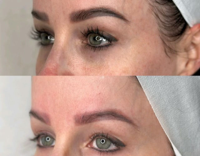 Microblading removal